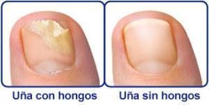 ANTI.HONGOS TOENAIL PLUS🌟🌟🌟🌟🌟