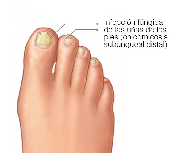 ANTI.HONGOS TOENAIL PLUS🌟🌟🌟🌟🌟